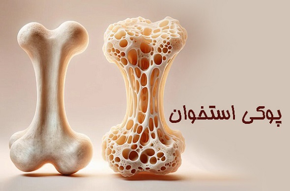 تأثیر تغذیه بر پوکی استخوان/ چه بخوریم و از چه پرهیز کنیم؟